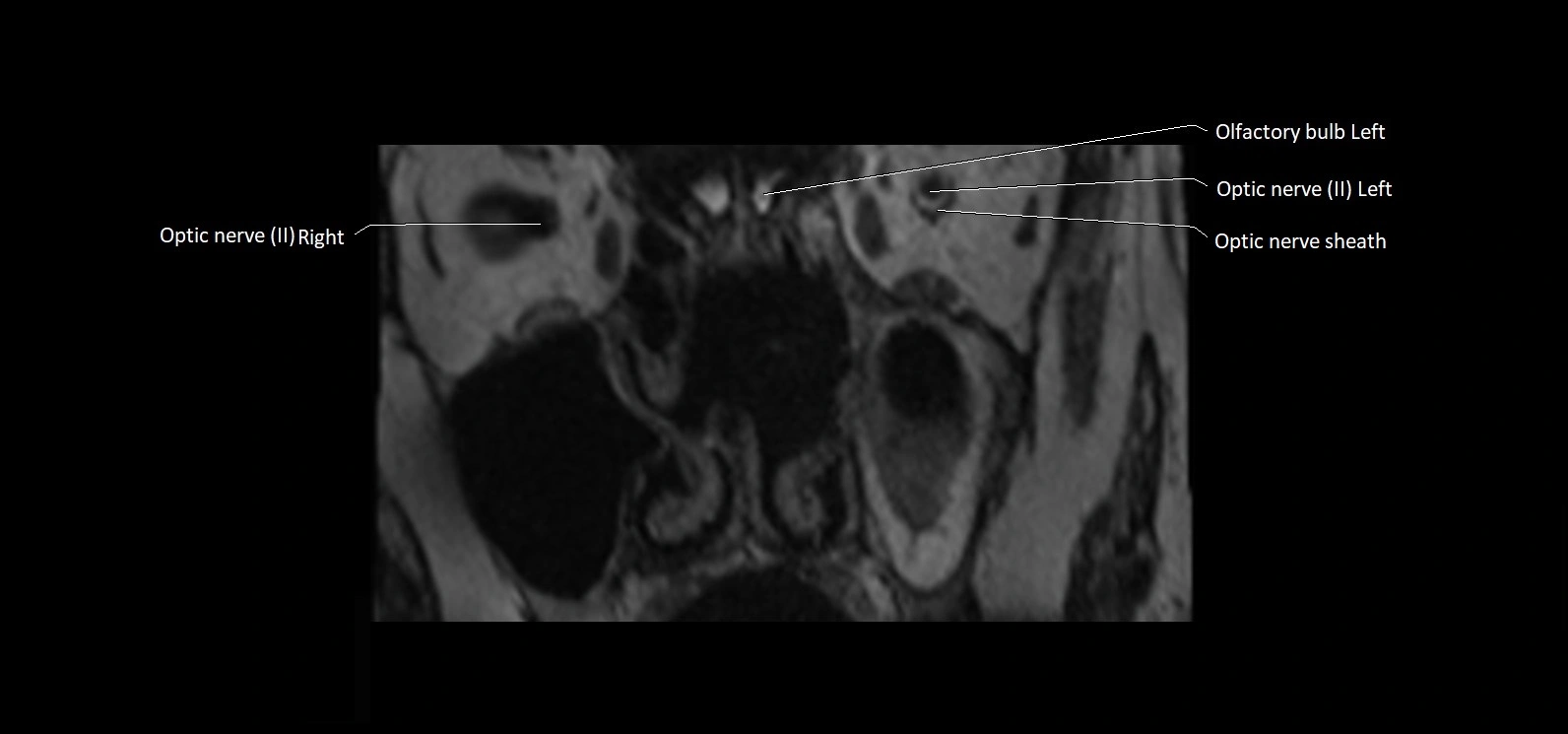 Cranial nerve cross sectional anatomy coronal 3T MRI image 1.webp